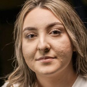 Benefits of an Anti-Inflammatory Diet for Acne-Prone Skin