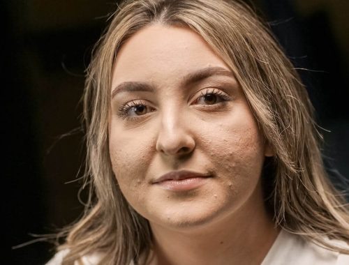 Benefits of an Anti-Inflammatory Diet for Acne-Prone Skin