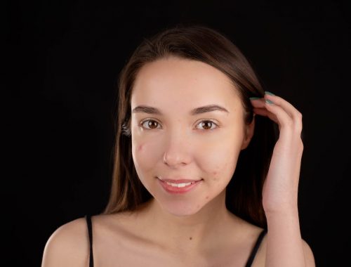 Connection Between Dairy and Acne